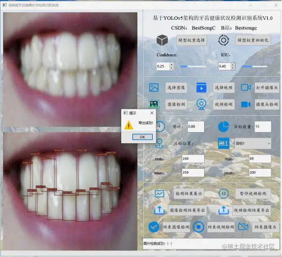 高精度牙齿健康状态检测识别系统447.png